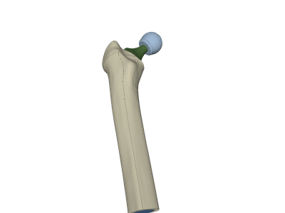 hip joint prosthesis image