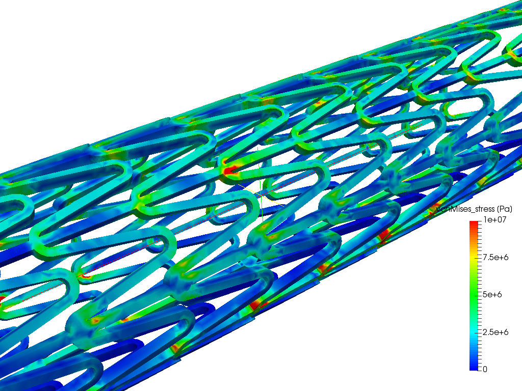 Stent by fandrosca | SimScale