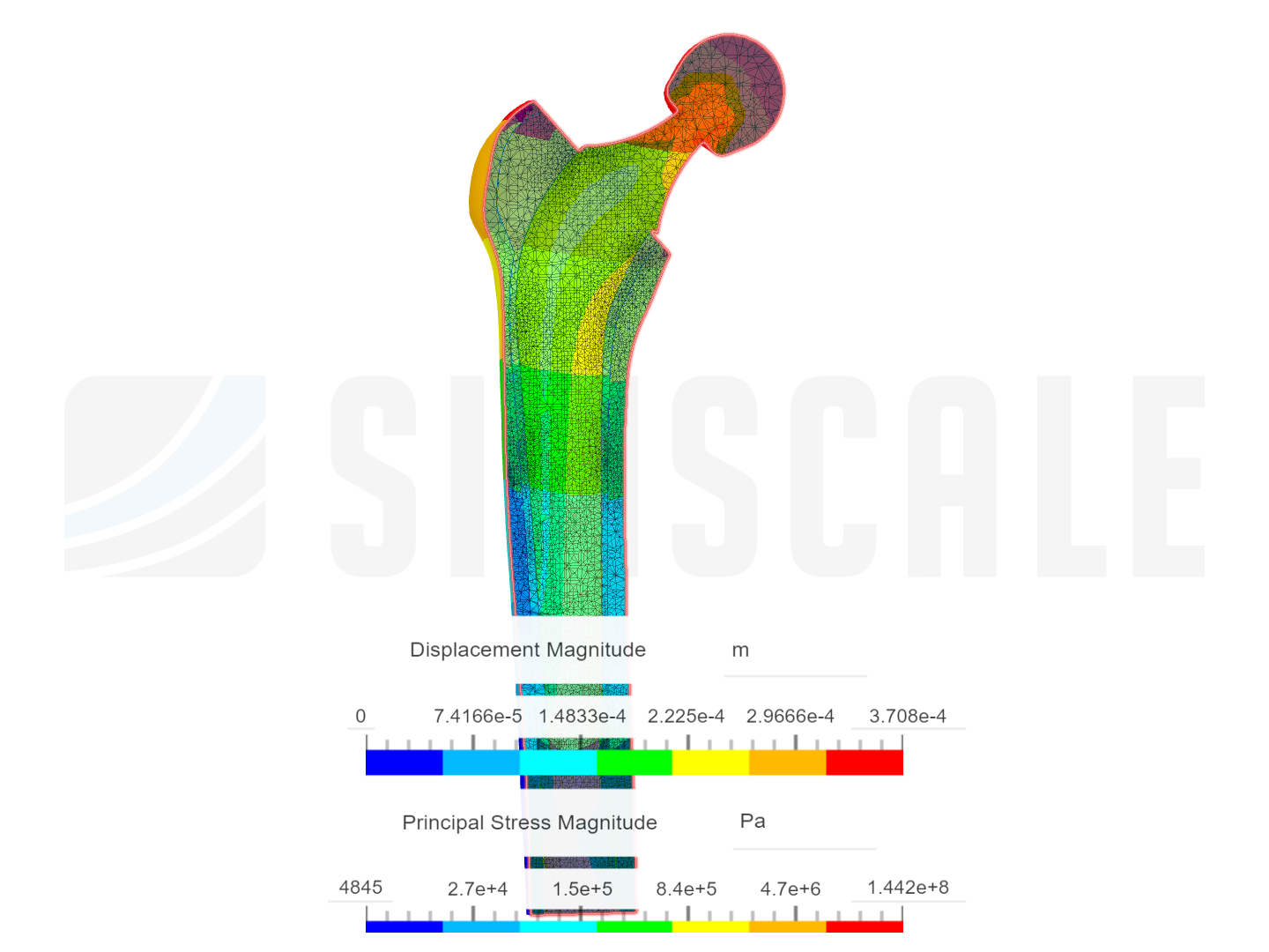 Biomechanics of Hip Joint Prosthesis by solomonberedugo | SimScale