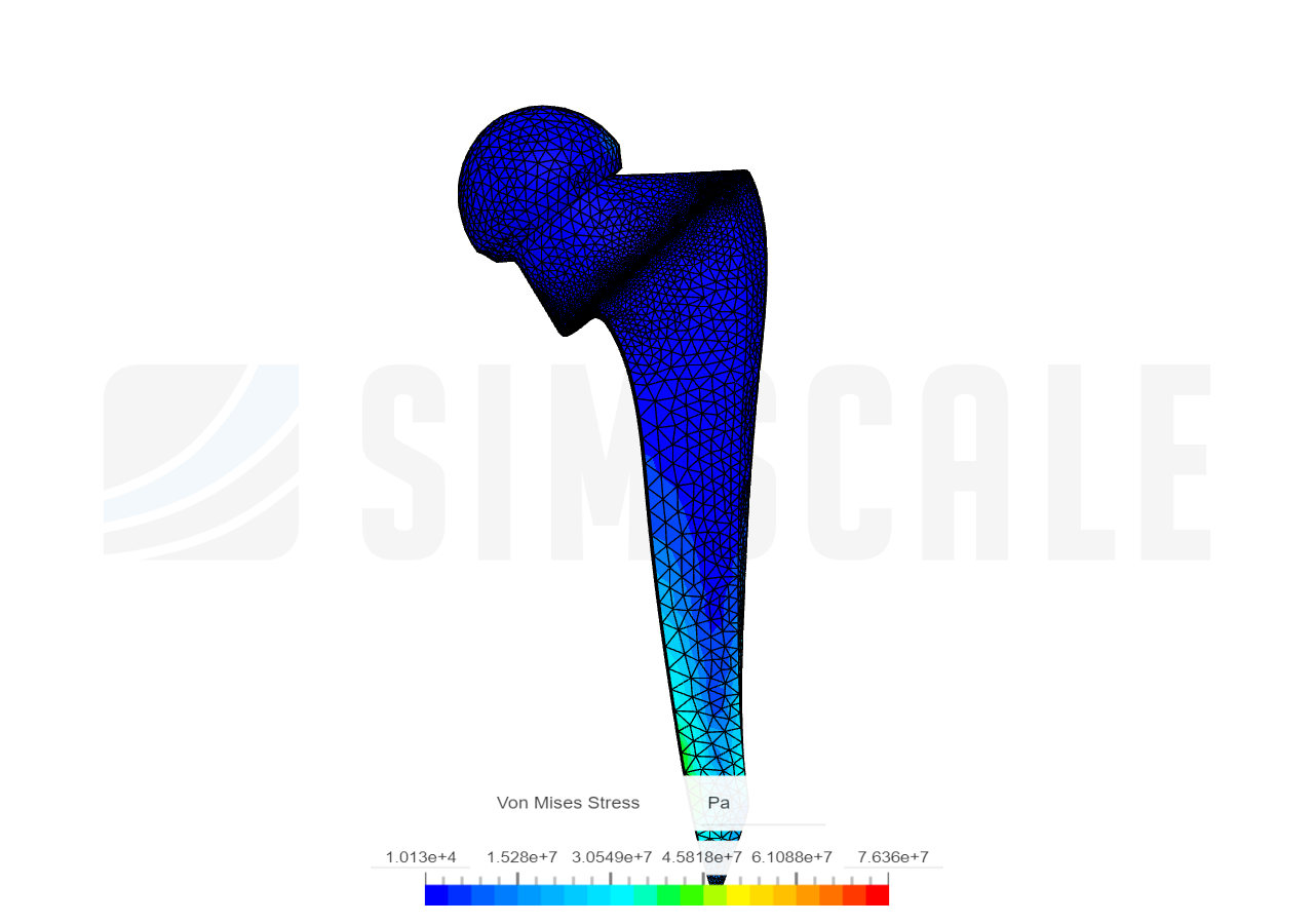 HIP Prosthetics - Srushti by srushtidongaon | SimScale...