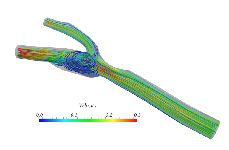 artery simulation with CFD biomedical engineering workshop, fluid flow simulation of vessel calcification